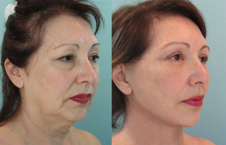 使用线紧致面部皮肤恢复活力的结果